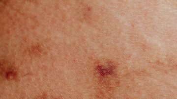 Wysypka na ciele – przyczyny, rodzaje i skuteczne sposoby leczenia